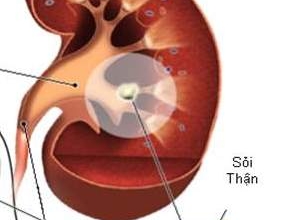Chế độ ăn uống cho người bị sỏi thận